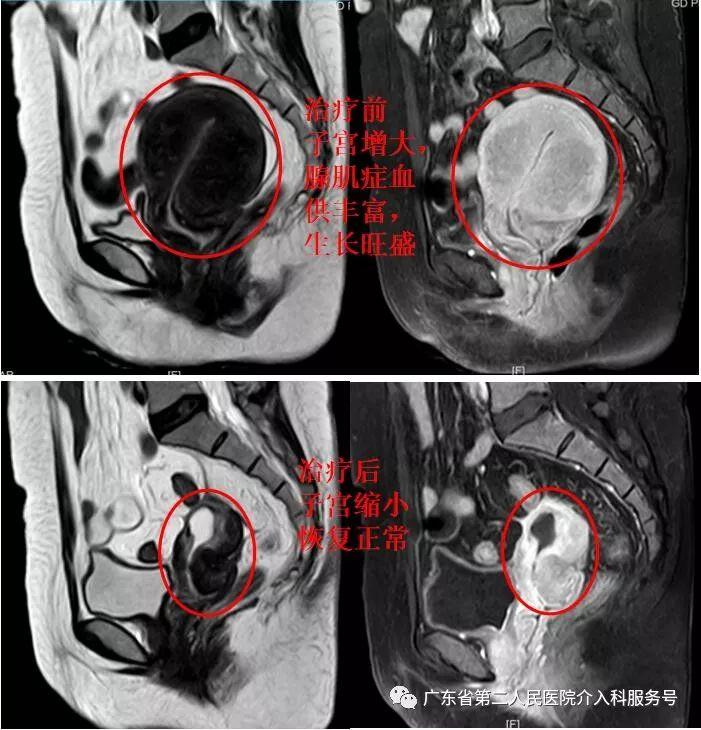 子宫腺肌症最新治疗,子宫腺肌症前沿治疗方法