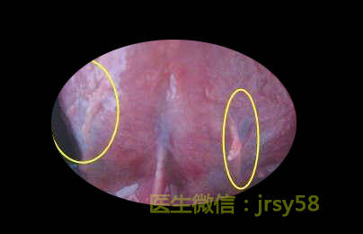 尖锐湿疣,近期频发的新型性传播疾病。