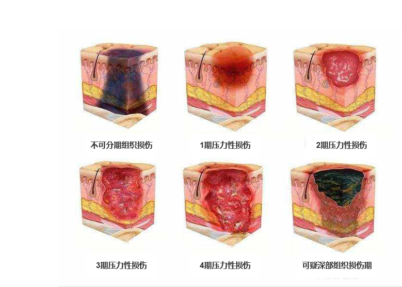 压疮分期最新,压疮分期新进展