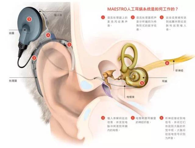 最新人工耳蜗,业界瞩目的新一代人工耳蜗