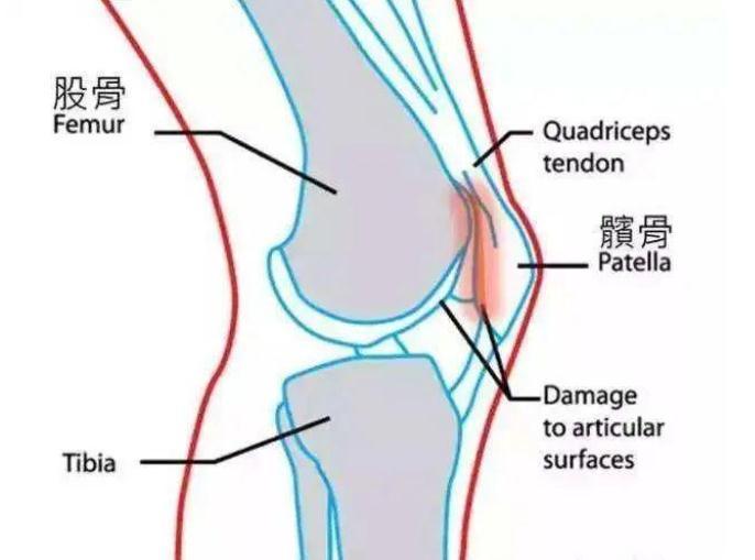 髌骨软化症最新疗法,探索髌骨软化症前沿治疗技术新突破