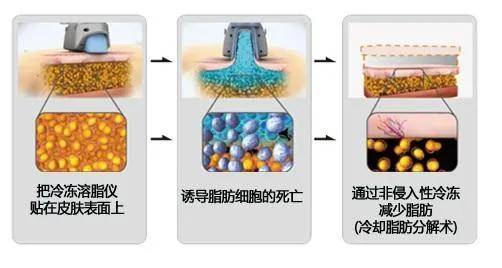 最新溶脂技术,行业领先、革新性的溶脂技术。