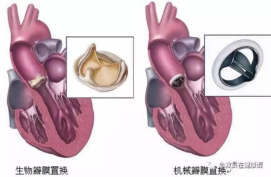 心脏换瓣膜最新技术,创新心脏瓣膜置换技术解析