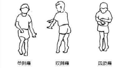 脑瘫最新分型,脑瘫新分类法介绍